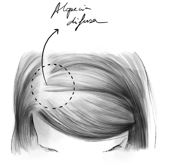 The Causes of Alopecia and How to Prevent It