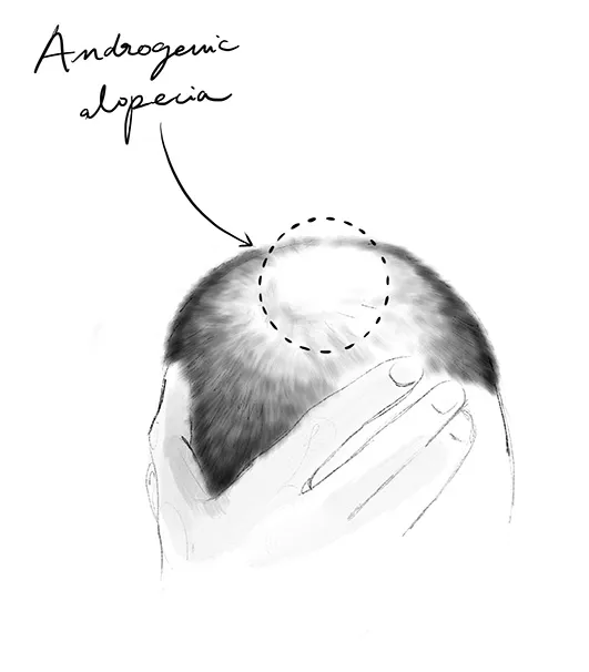 Androgenetic Alopecia Male