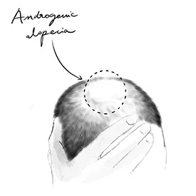 Androgenetic Alopecia Male