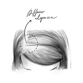 Diffuse alopecia